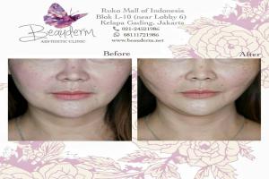 Tarik Benang (Threadlift)